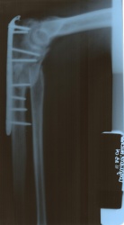 right_arm_xray.jpg